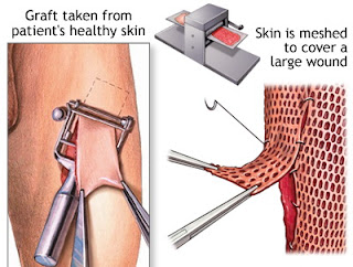 Asuhan Keperawatan Skin Graft