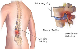  Nguyên nhân – triệu chứng – điều trị- thoát vị đĩa đệm thắt lưng