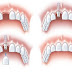 Trường hợp trồng răng implant mất ít thời gian ?