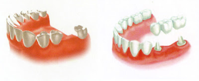 Trồng răng sứ và cấy ghép implant khác nhau không?