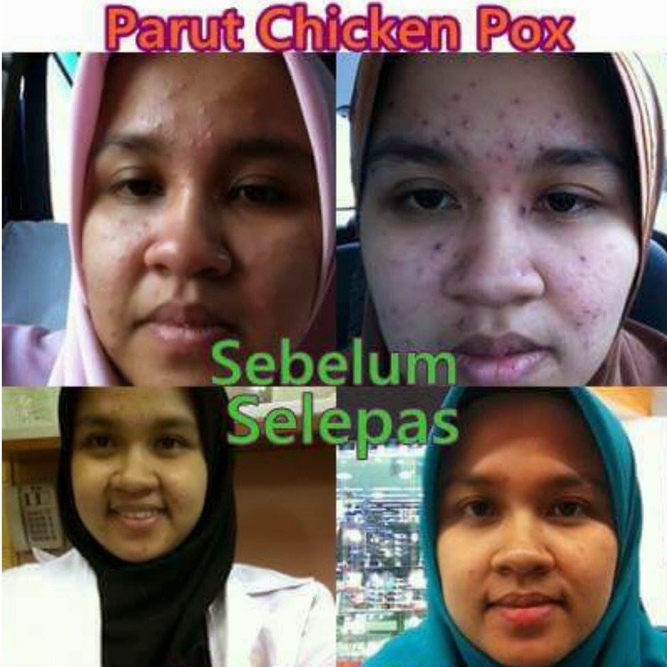 Parut Degil Chicken Pox Hilang - Petua Paling Mudah dan 