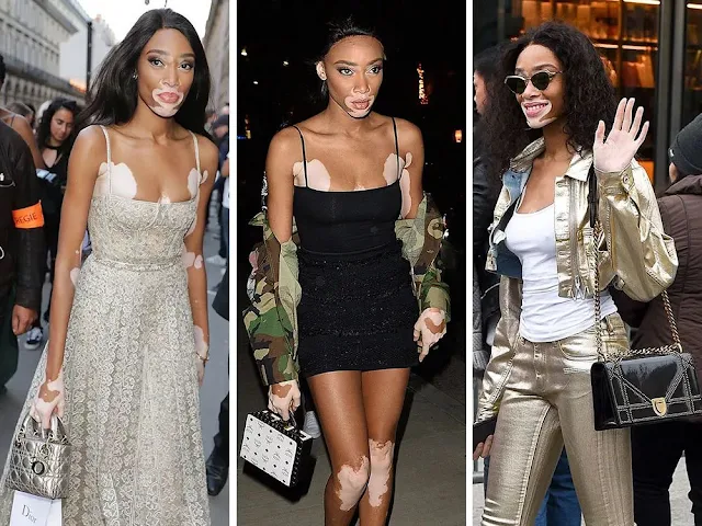 Modelo con vitiligo