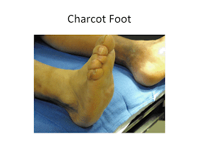 Foot Fracture Treatment-1.bp.blogspot.com the foot injuries and fractures structural foot deformities hammertoes