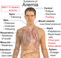 Anemia . Penyebab, Faktor Risiko dan Pencegahan