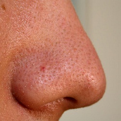 Como remover os pontos negros do nariz