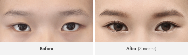 짱이뻐! - Korean Eye Plastic Surgery - Eyelid Revision