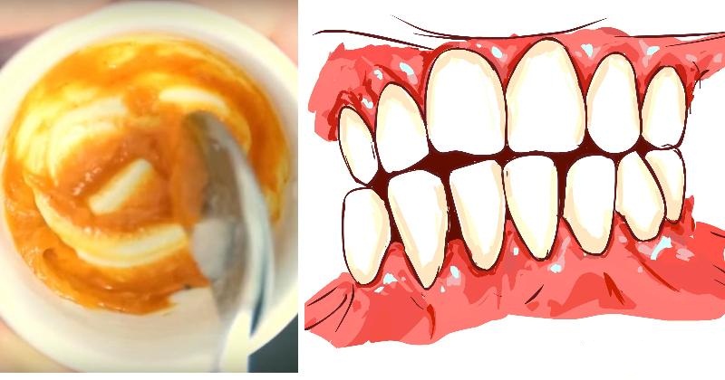 This Homemade Toothpaste Reverses Gum Disease and Whitens Teeth Naturally