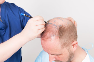 Hair Transplant Services Market