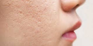 How to get rid of pimples and blackheads?