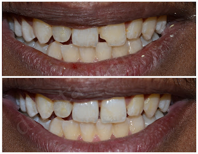 Composite Filling for Fractured Tooth
