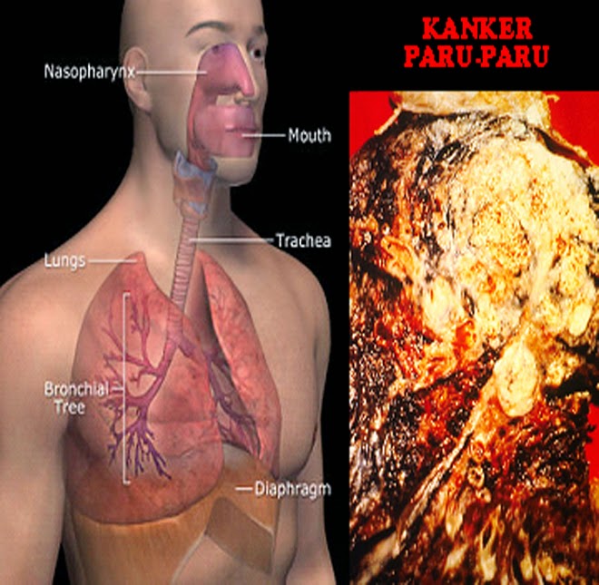 obat kanker Paru tradisional stadium 3, obat alami kanker Paru paru, alternatif kanker Paru stadium 4