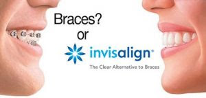Đặc điểm và quy trình niềng răng Invisalign là gì?