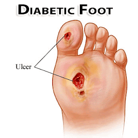 LAPORAN PENDAHULUAN DIABETES MELITUS (DM)