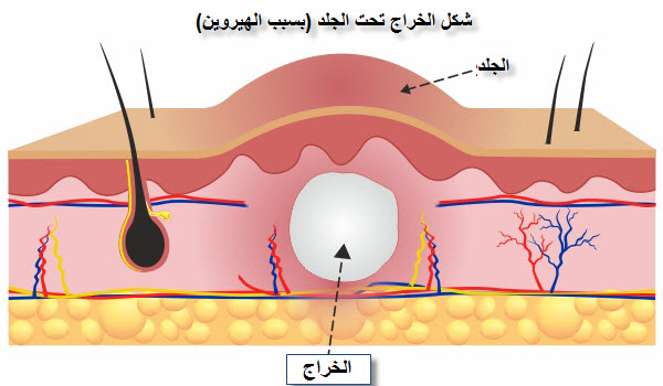 أسباب الخراج وكيف يتكون