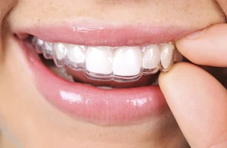 invisalign in Dubai