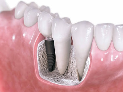 Cấy ghép Implant có an toàn không?