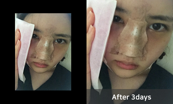 짱이뻐! - Surprised by Korea Rhinoplasty And More Satisfied By Envy And Jealousy From My Friends