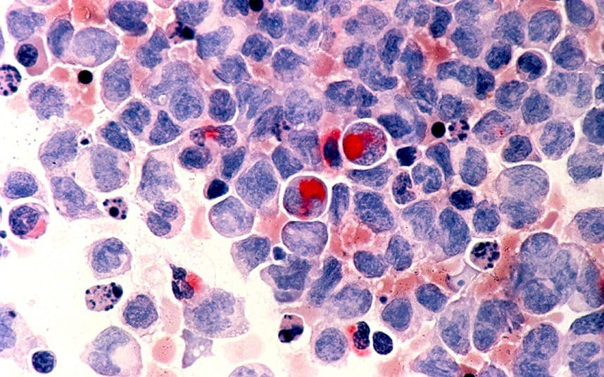 leukaemia