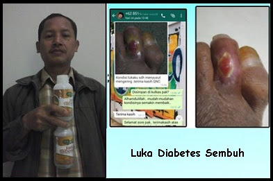 Obat Luka Borok Diabetes Yang Ampuh