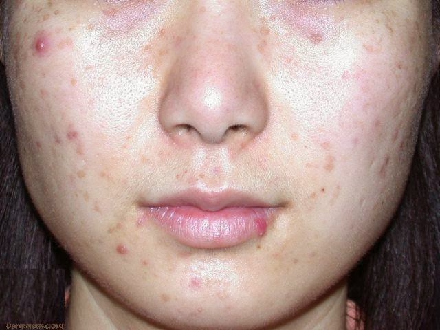 11. Home Remedies for Acne