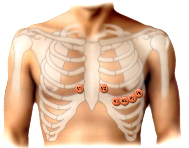 الشكل 16-16: تخطيط يبين موقع القطب النشط حول القلب في مسارات الصدر ( V1- V6 )
