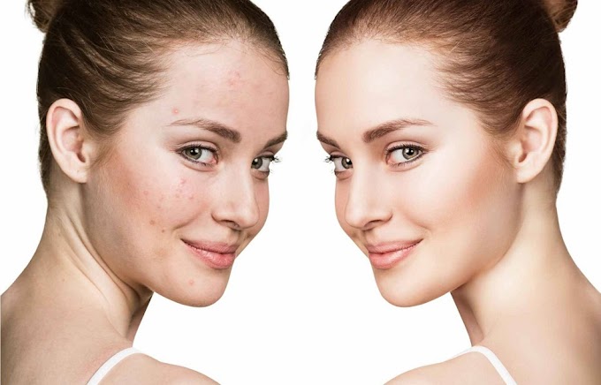 How Acne Is Treated