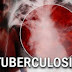 Pengobatan Dan Pencegahan Tuberkulosis Resisten Obat