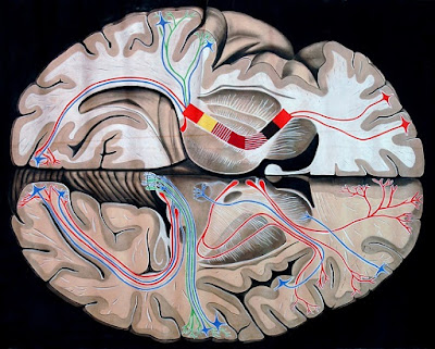 Ictus o accidente cerebrovascular