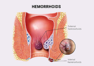 What is Hemorrhoids Disease
