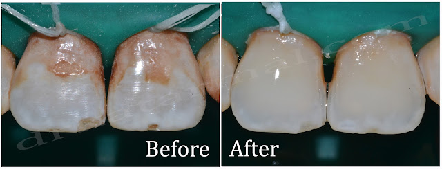 Treatment of Dental Fluorosis under Rubber Dam