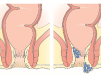 Obat Wasir Atau Ambeien Ampuh Pada Pria