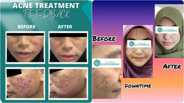 Koleksi gambar hasil rawatan kulit dan testimoni pelanggan Klinik Avicenna