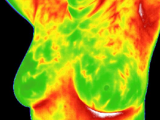 How Does Thermography Breast Cancer Screening Work?