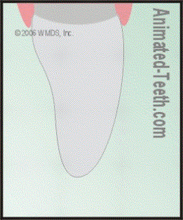 lumineers tooth