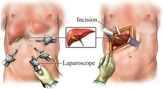 الفرق بين جرح عملية استئصال المرارة بالجراحة المفتوحة والمنظار