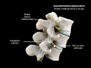 Espondilolistesis 