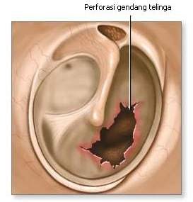 Penyakit Telinga  Hidung  dan Tenggorokan  Gangguan Telinga  