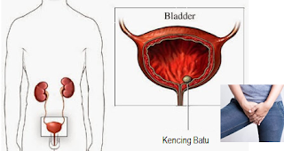 cara menghancurkan batu ginjal tanpa operasi,obat batu ginjal,obat kencing batu,cara mengeluarkan batu ginjal tanpa operasi,cara menghilangkan batu ginjal tanpa operasi