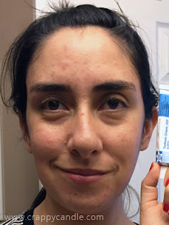 2 Months on Tretinoin Cream :: The Acne Experiment