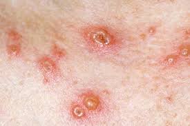 What is the best treatment for chicken pox?,How can chickenpox be treated or cured?,How long does chicken pox take to heal?,Can chickenpox be cured by antibiotics?