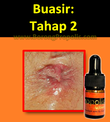 rupa buasir tahap 2