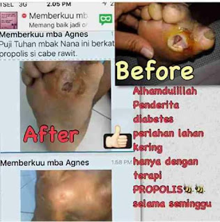 propolis en diabetes, diabete et propolis, propolis for diabetes, propolis gegen diabetes, propolis in diabetes, propolis luka diabetes, propolis diabetes mellitus, propolis menyembuhkan diabetes, propolis obat diabetes, propolis obat diabetes melitus, luka diabetes pakai propolis, propolis para diabetes, propolis untuk diabetes, propolis untuk diabetes kering, propolis untuk diabetes basah, propolis verde diabetes, propolis with diabetes, propolis x diabetes, propolis y diabetes, british propolis untuk diabetes, testimoni propolis untuk diabetes, testimoni melia propolis diabetes, testimoni propolis moment untuk diabetes, ,