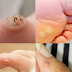 Be Very Careful: If You Notice This Skin Growth, It Could Be Serious