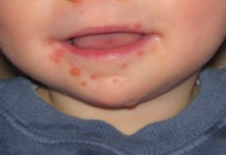 Le syndrome pieds-mains-bouche ou maladie mains-pieds-bouche est une maladie infectieuse virale se manifestant principalement chez les enfants, due à des entérovirus comme le virus Coxsackie A16 et l'entérovirus 71. Cette pathologie est le plus souvent bénigne.