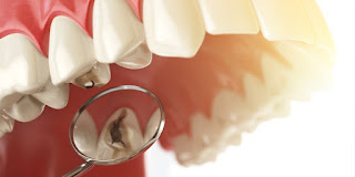 Fogorvos fogszuvasodás kezelés