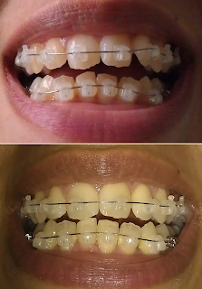 Before and after picture of Damon clear braces taken 3 weeks apart