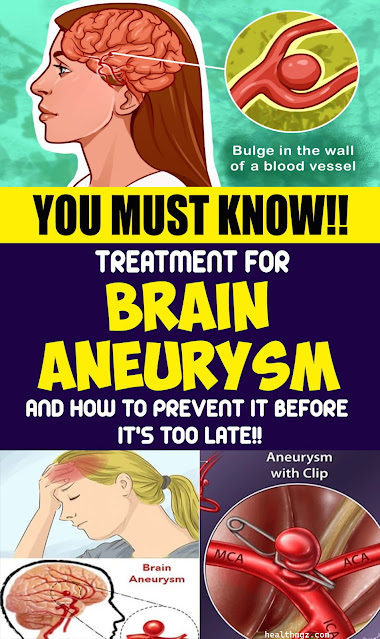 Treatment for Brain Aneurysm and How to Prevent it Before It’s Too Late!
