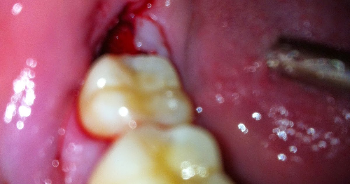 home remedies for pain after wisdom teeth removal