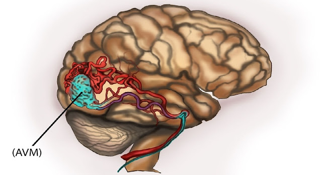 neurological disorder, neurologist, Neurologists, brian, brain tumour, cerebrovascular disease, brain health, mental health