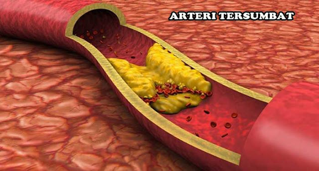Cara Menurunkan Kolesterol